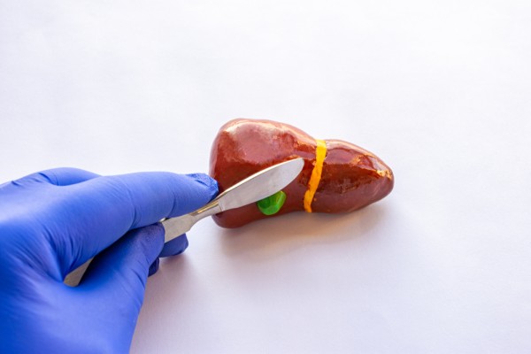 Frequently Asked Questions About Gallbladder Removal