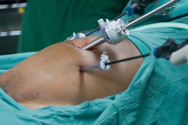 Follow Up Care For Laparoscopic Hernia Repair